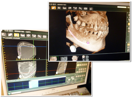 さがのあおい歯科：親知らずや根幹治療をより安全に治療するための診断・・・CTの導入 